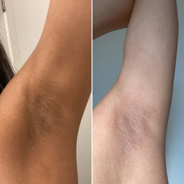 Bellaluny Peel-Shot Spray™