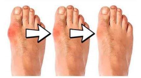 Siliconen hamerteencorrector